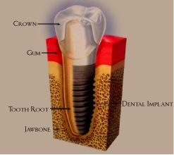 Dental Implants