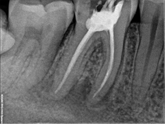 Root Canal Treatment