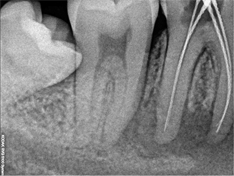 Root Canal Treatment